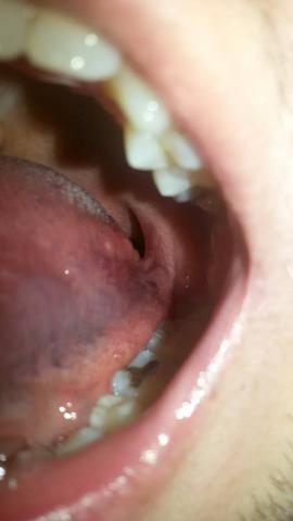 rechts - (Zunge, normal, Herpes)