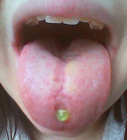 Hier meine Zunge - (Gesundheit, Weisheitszähne, Mund)