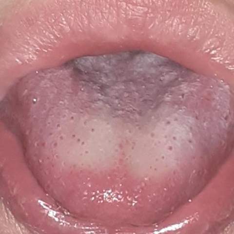 Zunge Seit Paar Tagen Taub Was Kann Ich Tun Gesundheit Und Medizin Lippe Zunge Seit Paar Tagen Taub Was Kann Ich Tun Gesundheit Und Medizin Lippe