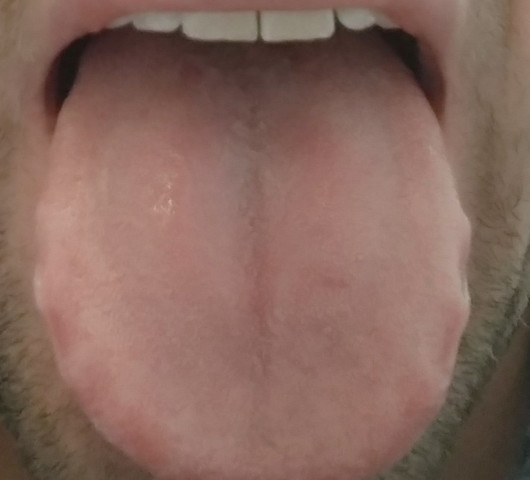 Zunge Seitliche Dellen Und Weisser Belag Gesundheit Und Medizin Krank Zunge Seitliche Dellen Und Weisser Belag Gesundheit Und Medizin Krank