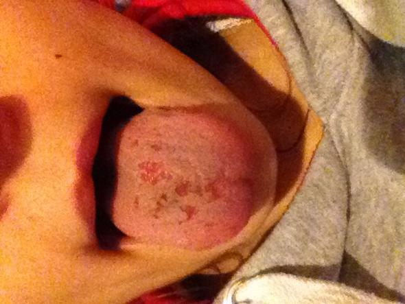 So sieht meine Zunge aus - (Zunge, Säure)