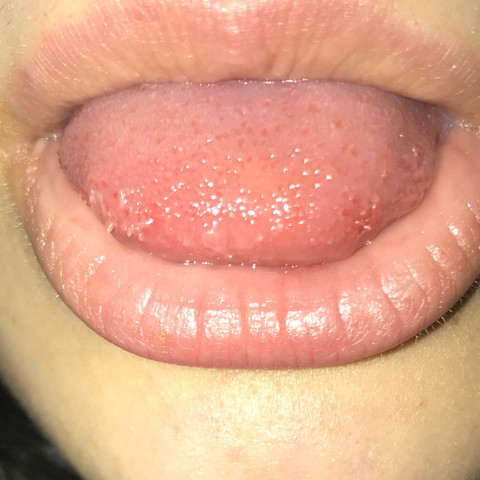 Punkte auf der Zunge - (Gesundheit und Medizin, Arzt, Schmerzen)