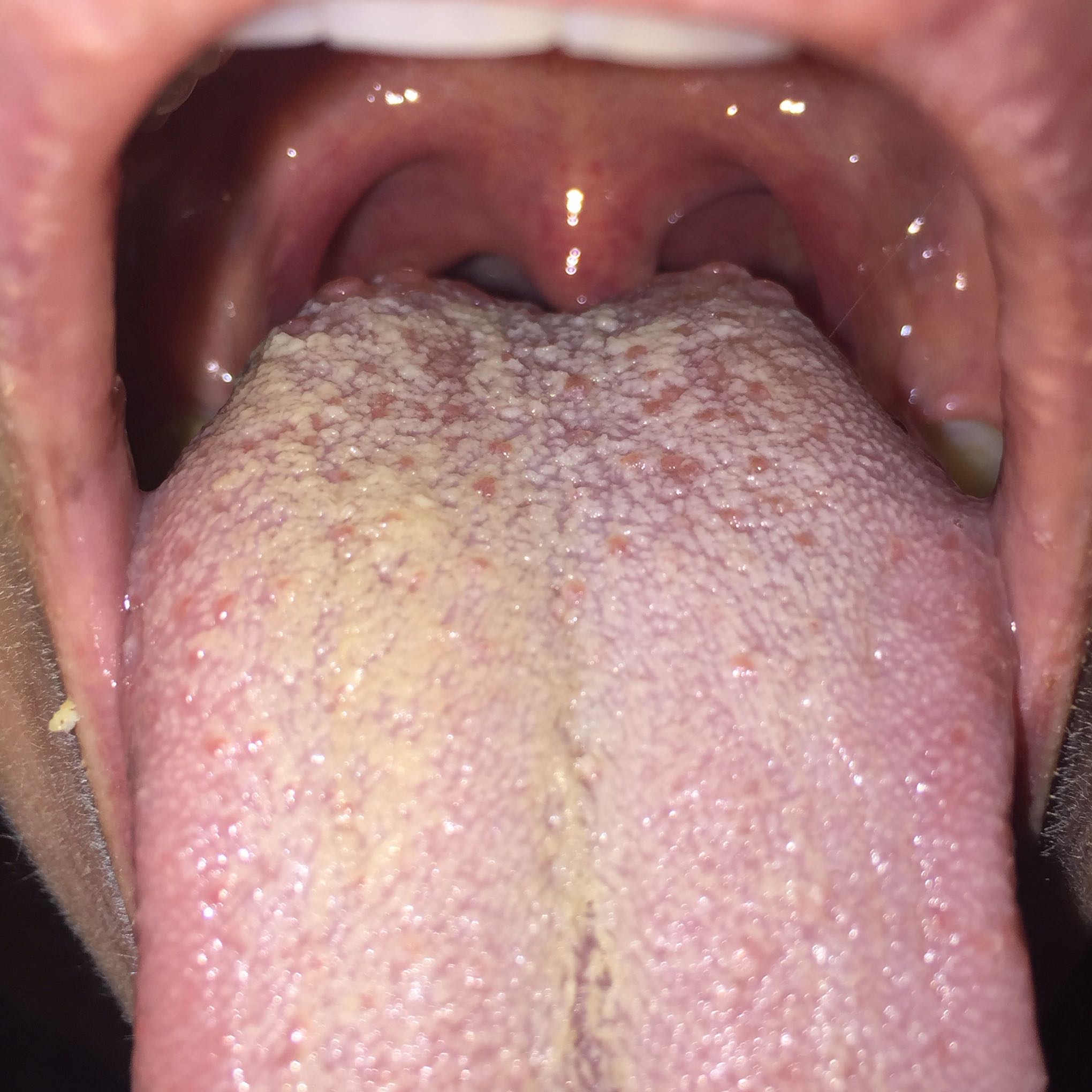 View Pickel Auf Der Zunge Ursachen Gif