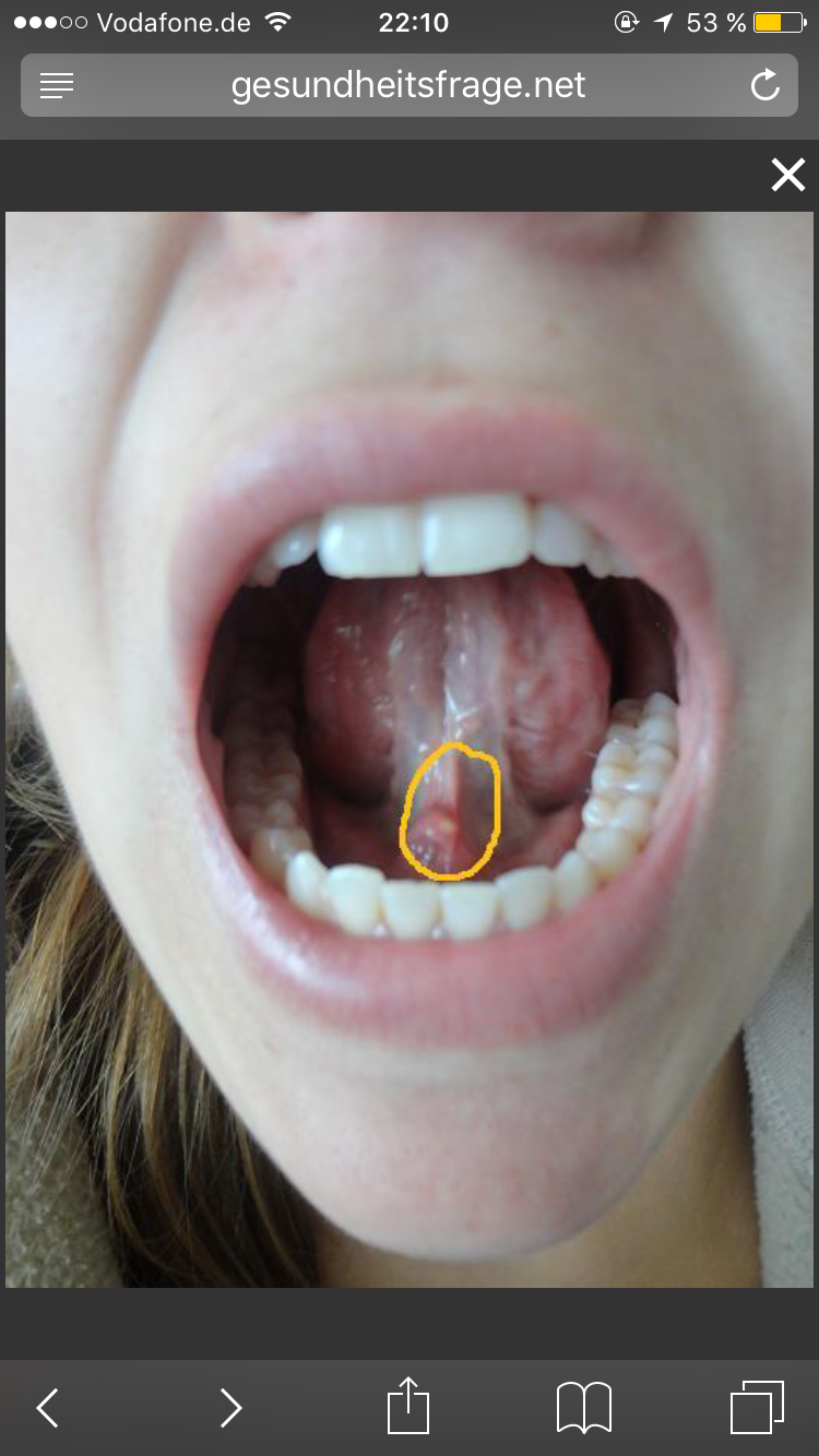 View Pickel Im Mund Wange Was Tun Images