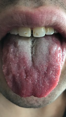 gerötete Zunge - (Lungenkrebs, Rauchstopp)