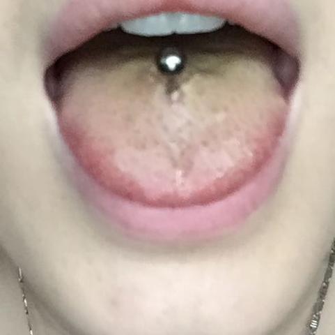 das kleine weiße ding vor meinem piercing  - (Entzündung, Zungenpiercing)