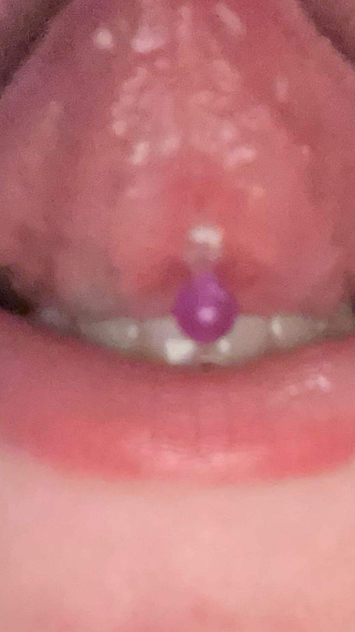 Zungenpiercing eitert? (Piercing, Entzündung, Zunge)