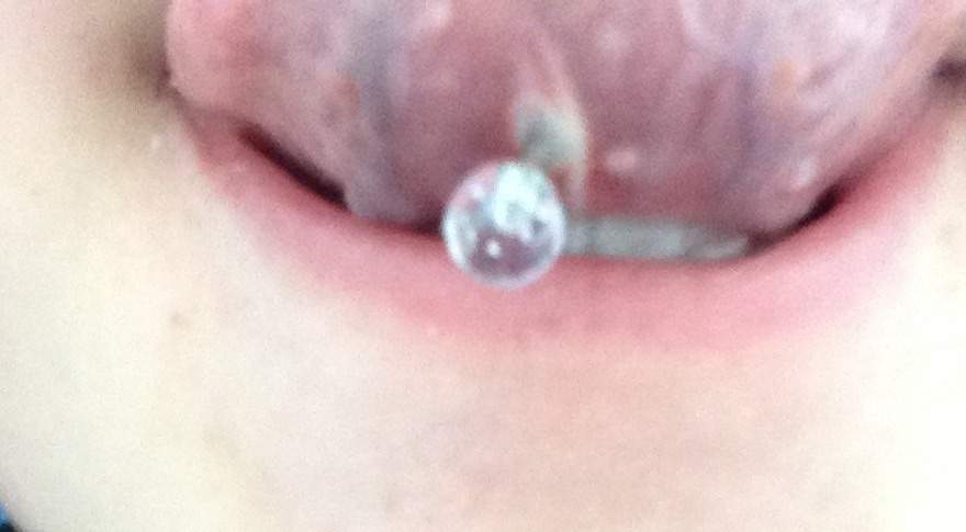 Unter der entzündung zunge zungenpiercing Zungenpiercing: Das