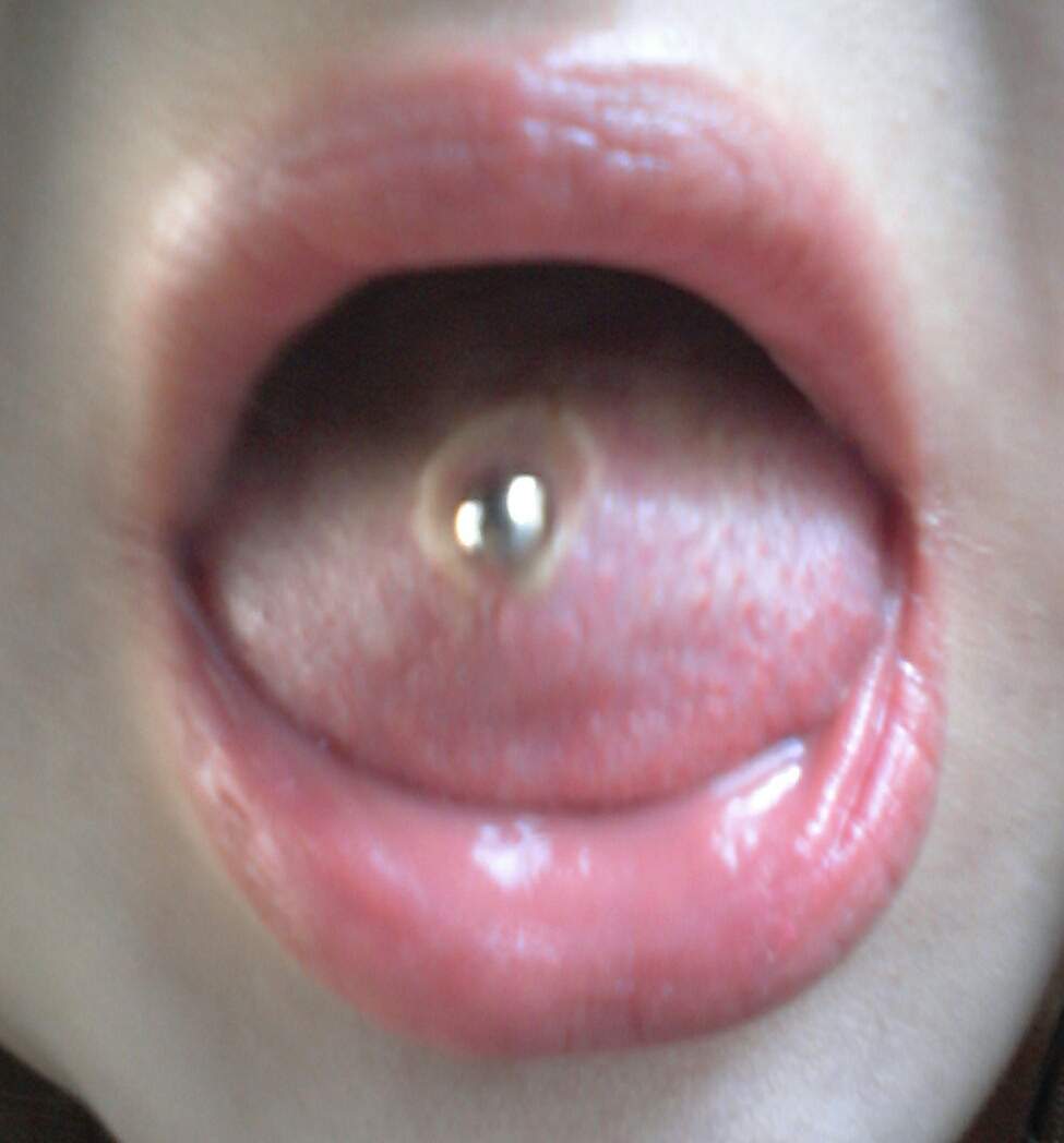Zungenpiercing Entzundet Und Vereitert Was Tun Korper Schmerzen Piercing Zungenpiercing Entzundet Und Vereitert Was Tun Korper Schmerzen Piercing
