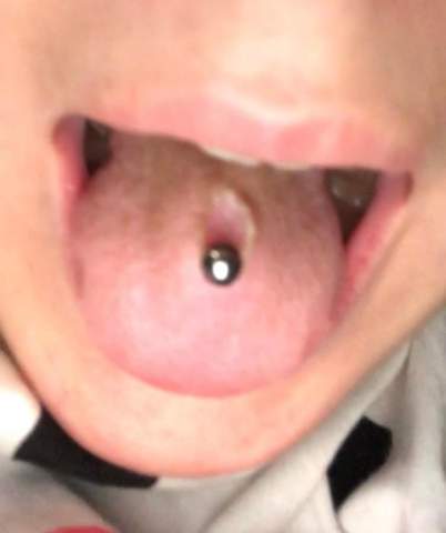 Zunge unter der zungenpiercing entzündung Zungenabszess