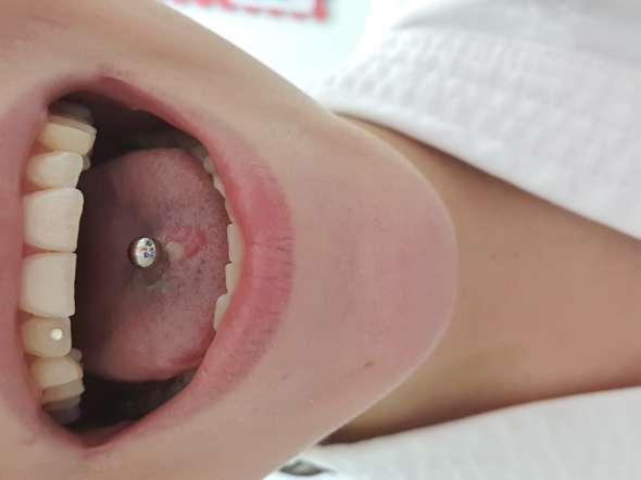Entzündung unter zunge zungenpiercing der Zungenpiercing entzündet: