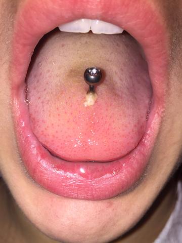 Zungenpiercing Nach 3 Tagen Eiter Piercing Entzundung Zunge Zungenpiercing Nach 3 Tagen Eiter Piercing Entzundung Zunge