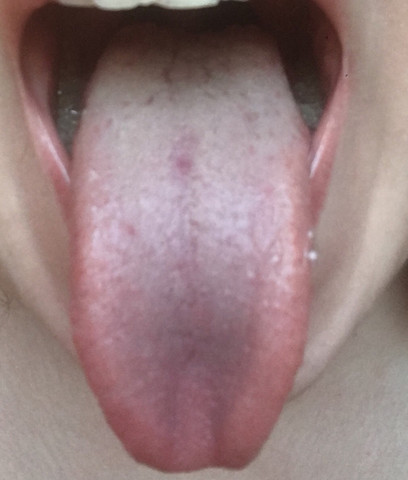 Zungenpilz Oder Was Ist Das Mit Bild Arzt Angst Krankheit Zungenpilz Oder Was Ist Das Mit Bild Arzt Angst Krankheit