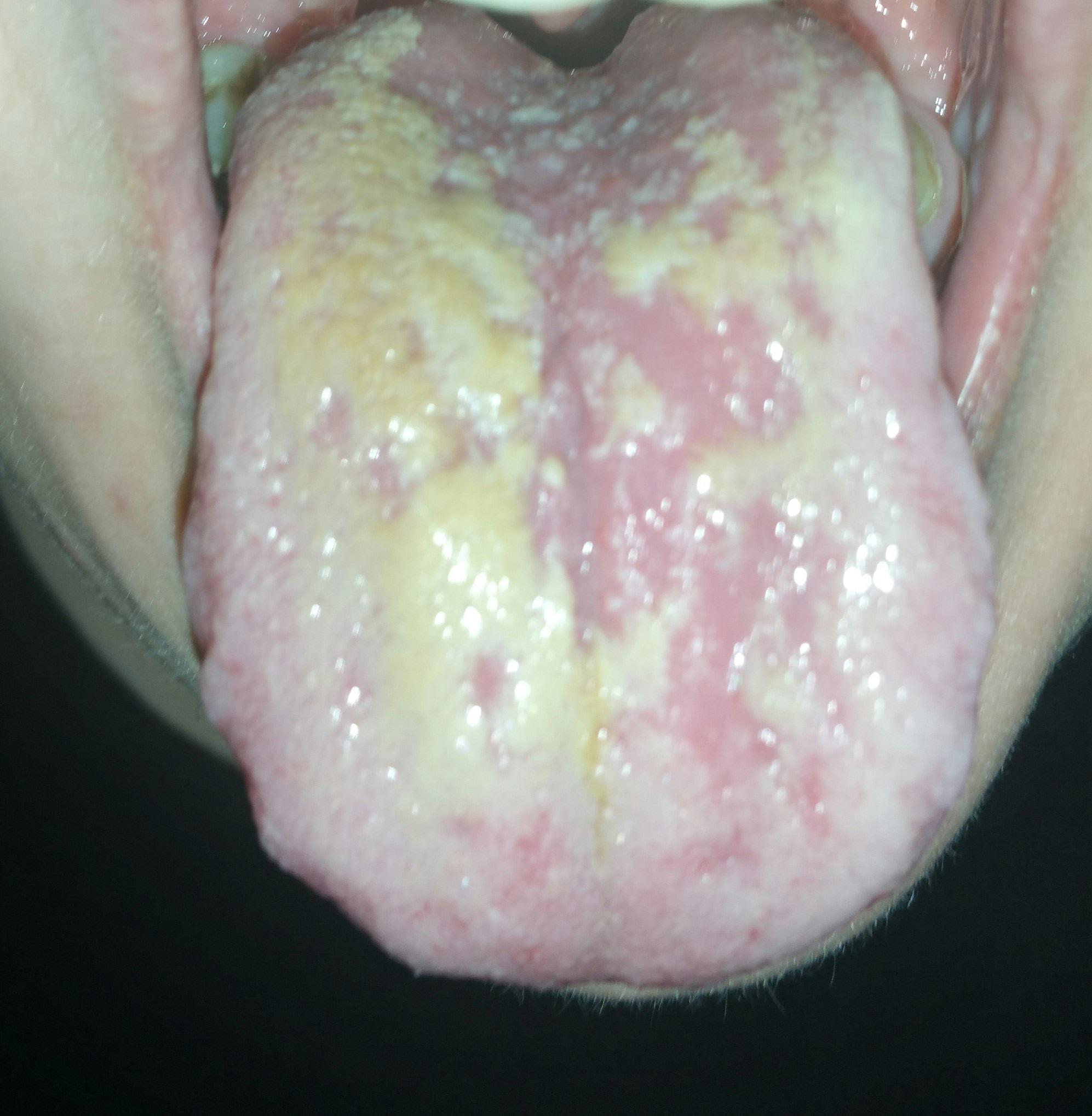 Zungensoor? (Mundhygiene, Zungenbelag)