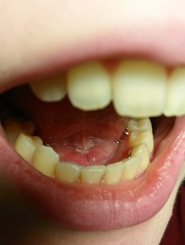 Hier noch mal der Teil unter der Zunge - (Schmerzen, Zähne, Entzündung)