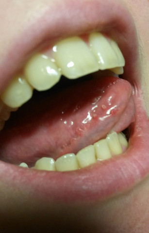 Die Zunge von der Seite - (Schmerzen, Zähne, Entzündung)