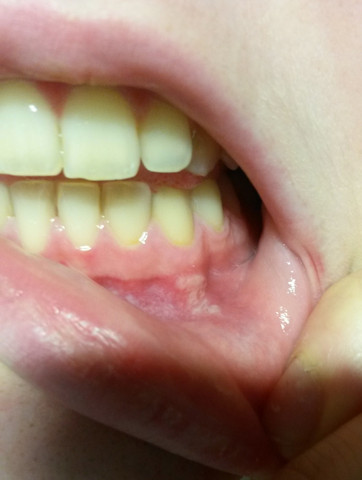 Das Wunde Zahnfleisch an einem der Zähne - (Schmerzen, Zähne, Entzündung)