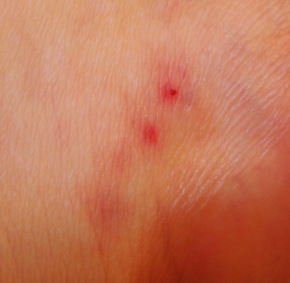 Welches Insekt hinterlässt zwei Stiche nebeneinander? (Gesundheit Welches Insekt hinterlässt zwei Stiche nebeneinander? (Gesundheit