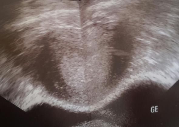Ultraschallbild - (Schwangerschaft, Zwillinge)