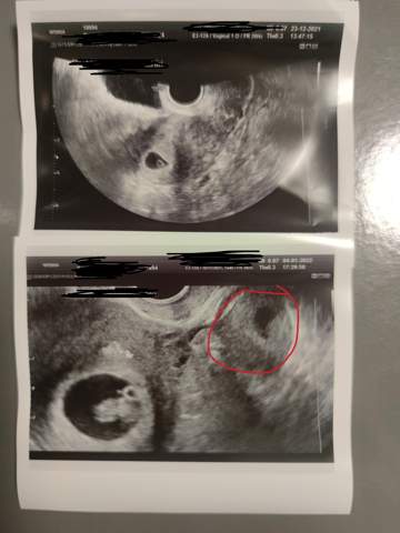 Zweite Fruchthöhle? (Schwangerschaft)
