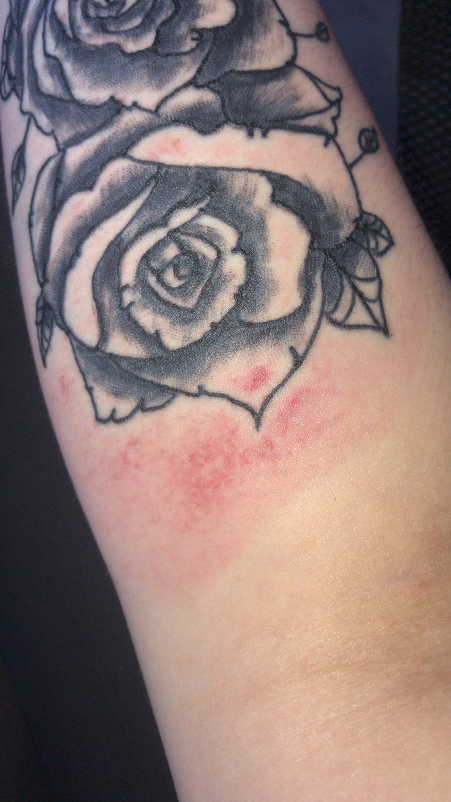 Krankheiten Von Tattoos