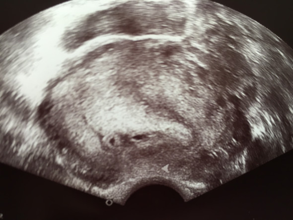 Ultraschall  - (Gesundheit, Schwangerschaft)