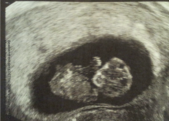Bild 1 - (Schwangerschaft, Baby, Gynäkologie)