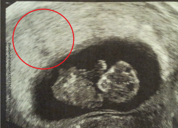 Bild 2 - (Schwangerschaft, Baby, Gynäkologie)