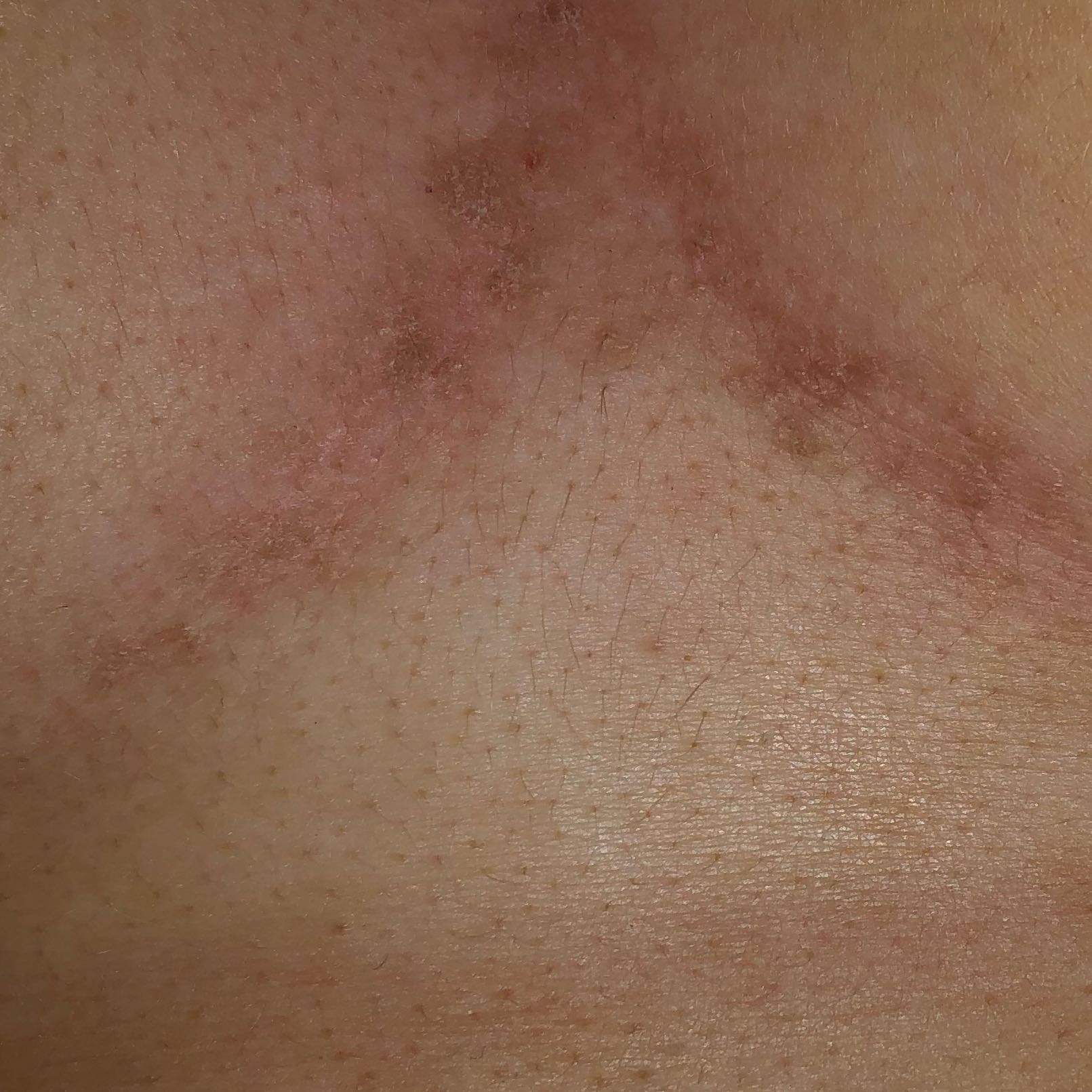 Zwischen den Brüsten trockene stellen? (Gesundheit und Medizin, Haut, Hautarzt)