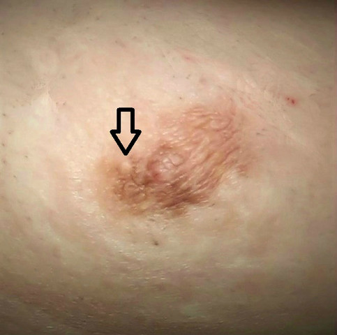 Zyste An Der Brustwarze Gesundheit Und Medizin Brustwarzen Zyste An Der Brustwarze Gesundheit Und Medizin Brustwarzen